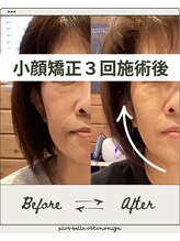 プルベル 宇都宮店(Plus Belle)/小顔矯正/たるみ改善/しわ改善