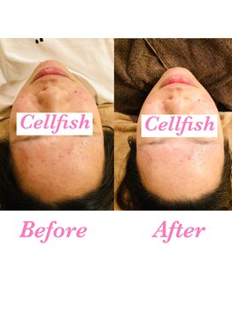 セルフィッシュ(Cellfish)/小顔矯正＆ハーブピーリング1回