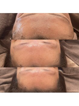 ミヨン ヨコハマ(Miyonne Yokohama)の写真/毛穴開き・シワにお悩みの方へ!40代50代のための本格毛穴ケア体験♪