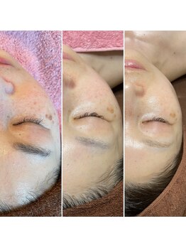 ルーチェエムベルシック(Luce.MBelChic)/エクスビアンスピーリング