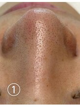 ビアンカーラ(Biancara)/【韓国式3D毛穴洗浄】施術前