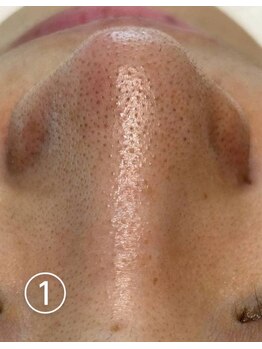 ビアンカーラ(Biancara)/【韓国式3D毛穴洗浄】施術前