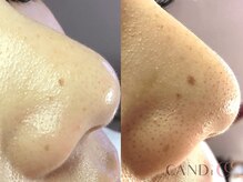 キャンディ 大阪梅田店(CANDi)/ハイドラピーリング/黒ずみ毛穴