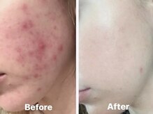 ヨソイ(yosoy)/ハーブピーリング