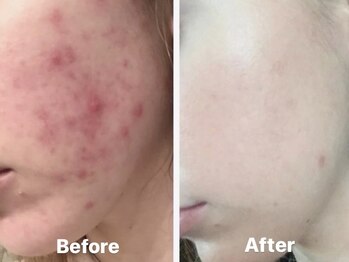 ヨソイ(yosoy)/ハーブピーリング