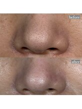 ライカブルー(RaicA BluE)/施術写真　before-after