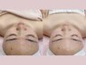 【時短×美肌】お悩み解決！光フェイシャル＋鎮静パック8800→5500円