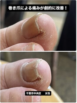 巻き爪の痛みが初回から軽減！