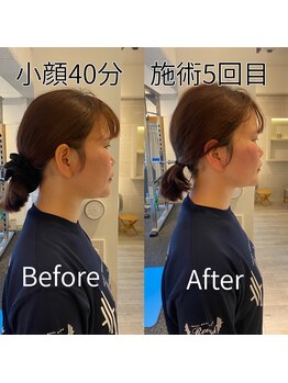 リバイブ 五反田店(REVIVE)/小顔矯正5回でリフトアップ