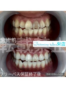 ホワイトニングサロン 名古屋 栄店/【ホワイトニング】