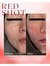 ベル(BELLE)/レッドショット２cc