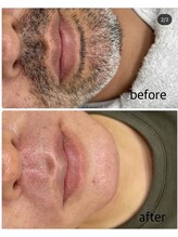 ソワイユ 浜松店(Soyeux)/ワックス脱毛（Wax xxx）