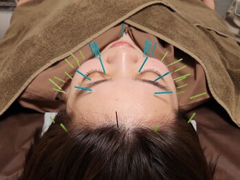 アントルーチェ 代々木上原(Entluce.)の写真/【徹底的に理想の小顔を叶える！】顔の筋肉を美容鍼でリフトアップ＋フェイスラインを引き締めます♪