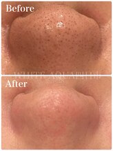 ホワイトアクア 四日市店(WHITE AQUA)/ハイドラ毛穴洗浄/毛穴改善