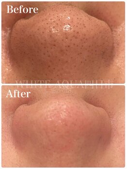 ホワイトアクア 四日市店(WHITE AQUA)/毛穴洗浄/毛穴改善