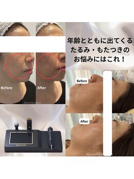 マウム(Maum)の写真/韓国で人気！高周波×吸引リフティングでほうれい線・たるみへアプローチ◎