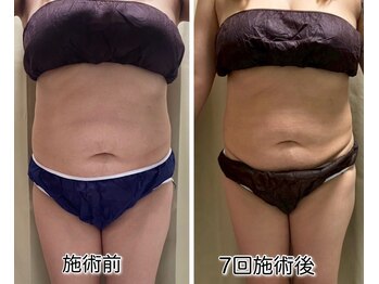 クールスパ(COOL SPA)/ &nbsp;【40代女性】お腹-6.5cm