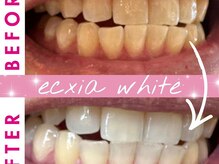 エクシアホワイトニング 姫路店/歯のビフォーアフター