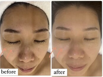 ミルジュ(MiLuJu)/マーメイドトリートメント