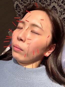 もりわき骨盤鍼灸整骨院 梅田院の写真/美容鍼で小顔&美肌が叶う！肩甲骨はがしとセットで首肩こり改善・美姿勢に♪【美容鍼+肩甲骨はがし】