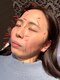 もりわき骨盤鍼灸整骨院 梅田院の写真/美容鍼で小顔&美肌が叶う！肩甲骨はがしとセットで首肩こり改善・美姿勢に♪【美容鍼+肩甲骨はがし】