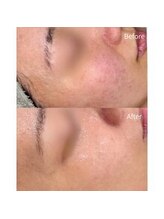 ミリ(MiLi)/スキンメイド