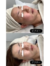 メリアミーゴ(Meli amigo)/30代　ハーブピーリング