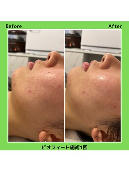 アガットバイミヤモト(agate by miyamoto)/ビオフィート（毛穴）施術1回