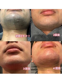 イデアル(ideal)/ひげ脱毛