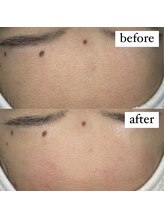 テンパ ビューティー(+10%beauty)/一撃タマゴ肌ワックス