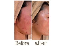 【肌質改善】小顔リフトアップが得意です！根本からお肌を変化！