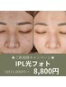 ★驚愕の美肌体験★ プラズマパールリフト☆光フォト　11000円→8800円