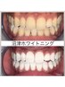 ホワイトニング80分照射(計2来店)¥12,000