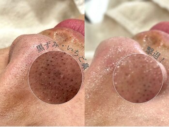 スー 千種 今池(Suu.)/韓国式毛穴洗浄"アクアピール"