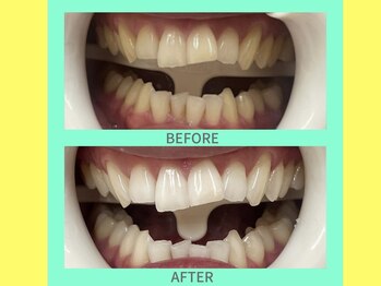 ココティ ホワイトニング(Cocotii)/ビフォーアフター