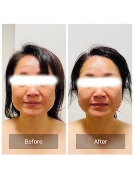 ヒール(heal)/【50代】くすみと緩みが悩み