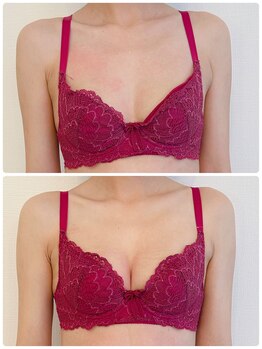 アンドモア(&more)/バストアップ症例!