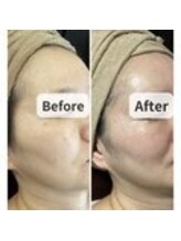 ル ボヌール 伊那店(le bonheur)/シミ改善コース5回目！