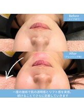 ハーモニー(Harmony)/鍼×幹細胞でつや肌小顔！