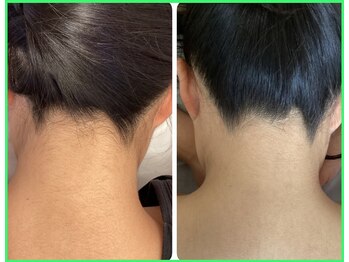 クリア 尾張旭店(Clear)/【Clear脱毛ビフォーアフター】