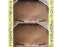 ハニエル(Haniel)/カーボキシー症例