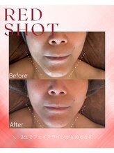 ベル(BELLE)/レッドショット２cc