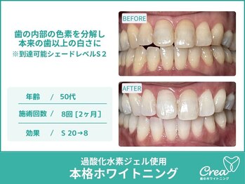 クレア(Crea)/【ホワイトニング症例写真】