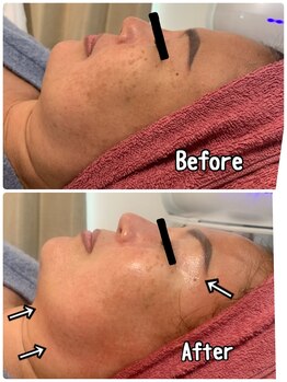 ブランシュール/小顔×エンビロン美白コース