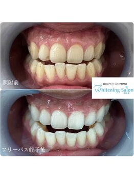 ホワイトニングサロン 熊本店/簡単セルフホワイトニング
