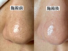 エミナル(eminal)/ビフォー/アフター/毛穴/ニキビ