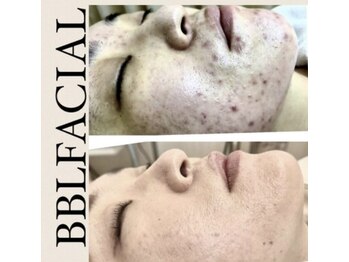 ヴィアージュ/最強のニキビケア！！！