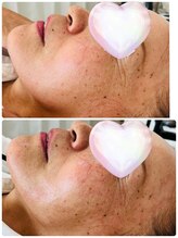 クリア アイラッシーズ アンド ネイルサロン シャイン(CLEAR & SHINE)/ヴィーナスカレント1回目