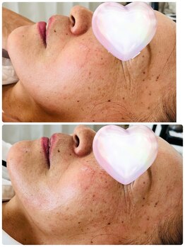 クリア アイラッシーズ アンド ネイルサロン シャイン(CLEAR & SHINE)/ヴィーナスカレント1回目