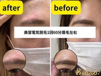 エステビビ 町田店(エステBiBi)/アイブロウ美容電気脱毛